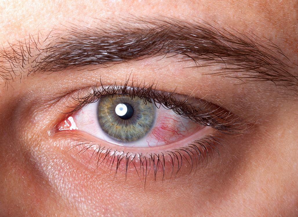 What you need to know about Dry Eyes
